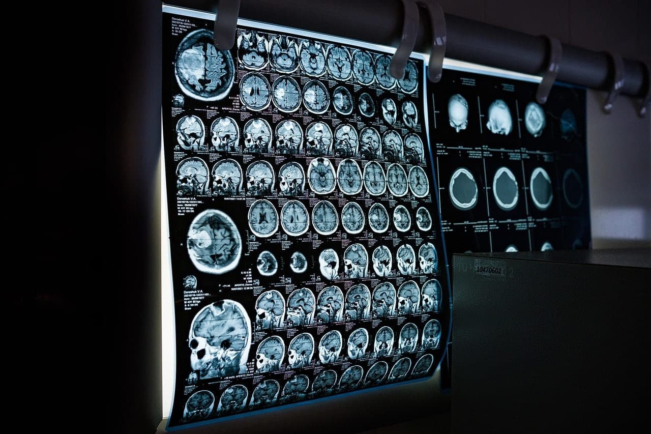 Niedrigdosis-CT: أشعة مقطعية بجرعة إشعاع منخفضة، تستغرق دقائق فقط CT scan machine hospital radiology low dose screening