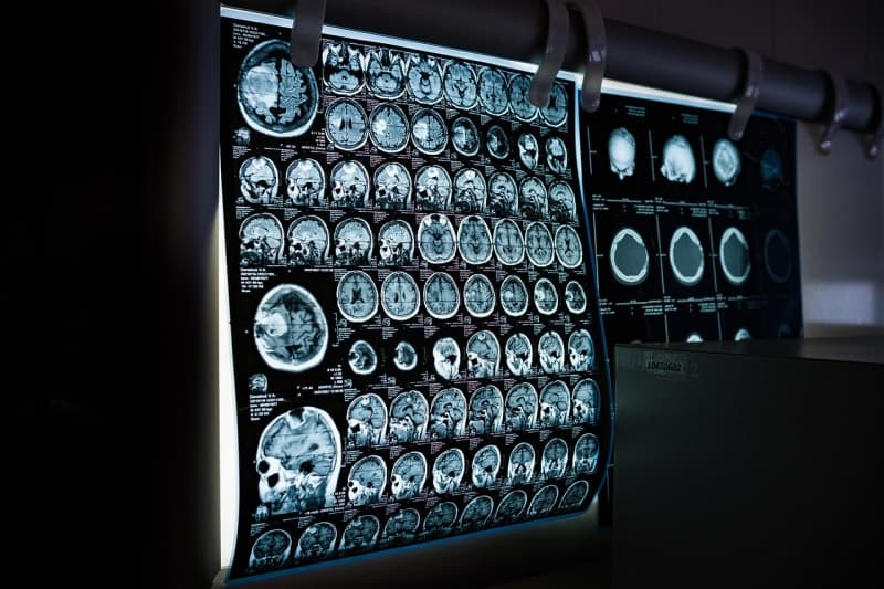 Niedrigdosis-CT: أشعة مقطعية بجرعة إشعاع منخفضة، تستغرق دقائق فقط CT scan machine hospital radiology low dose screening